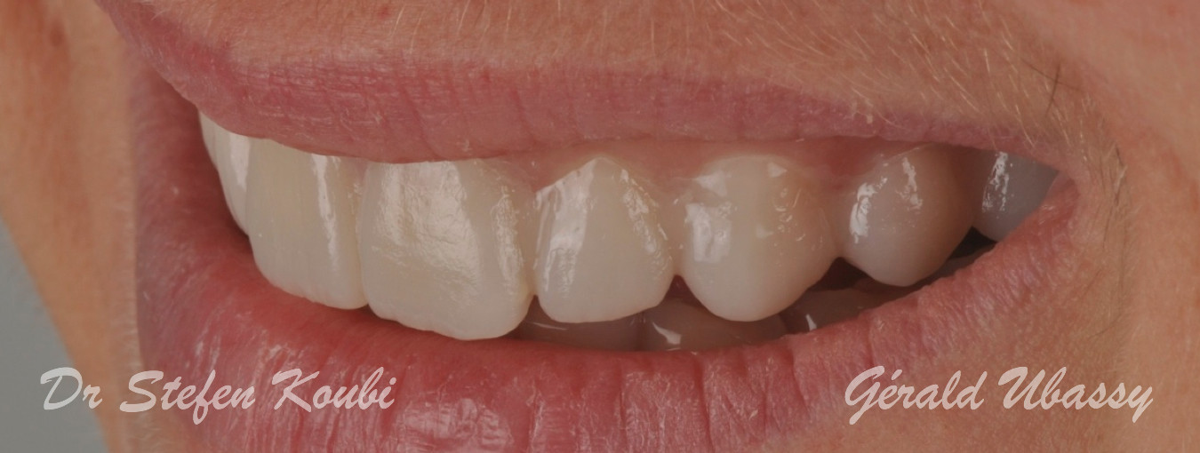 Veneers Dr Koubi/Ubassy